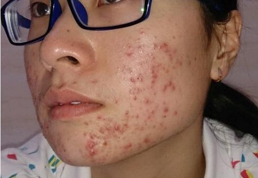 如何去除青春痘，男生的護(hù)膚指南，男生護(hù)膚指南，如何有效去除青春痘