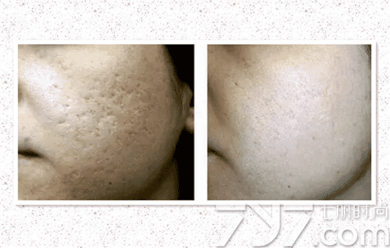 5次點(diǎn)陣激光去痘坑效果深度解析，五次點(diǎn)陣激光去痘坑深度解析，效果與影響探討