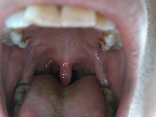 嗓子感覺糊了一層粘液，原因、緩解與預防策略，嗓子糊粘液，成因、緩解及預防策略