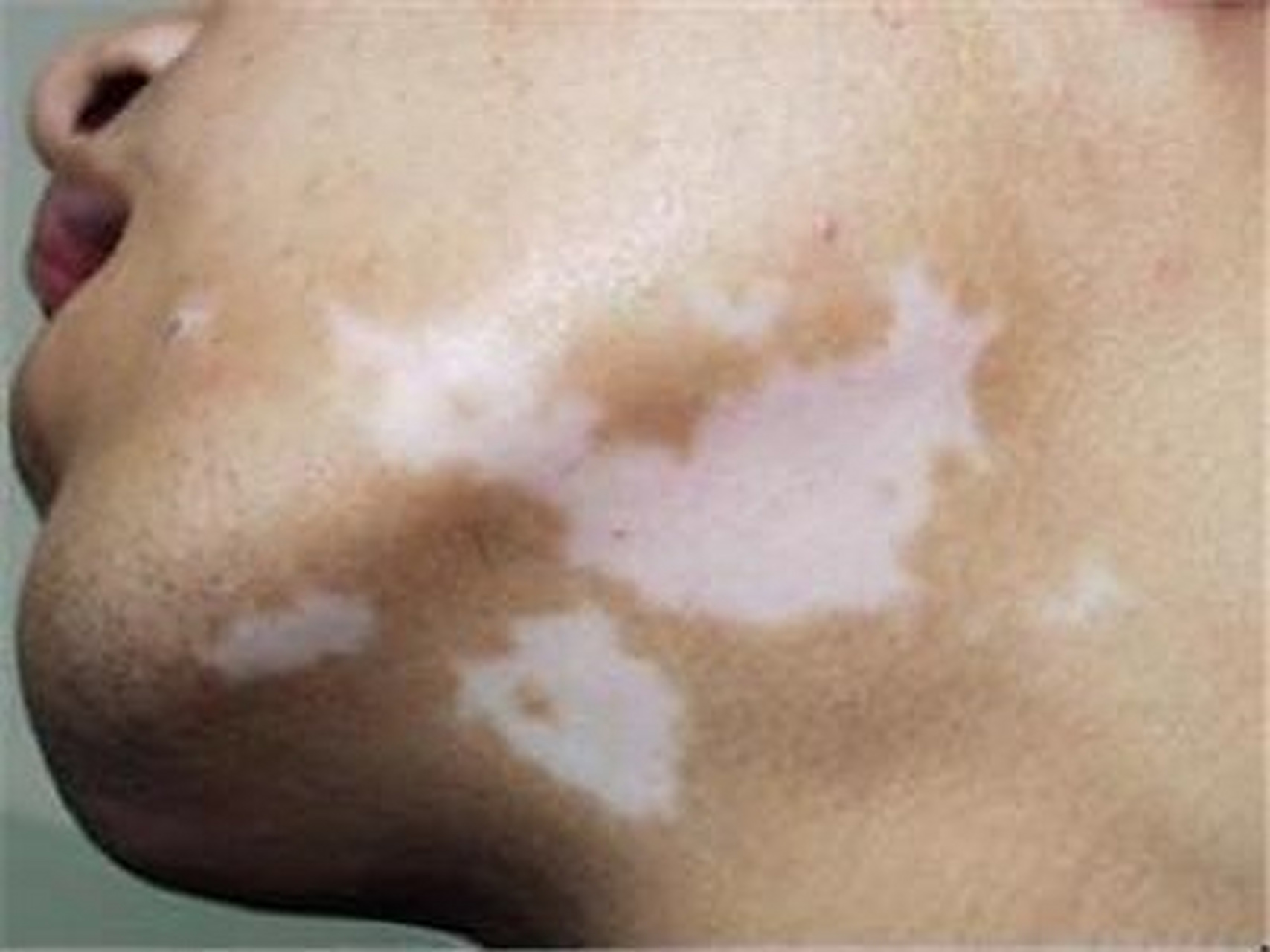 白點癲風怎么治療效果最好，全面解析最佳治療方案，全面解析白點癲風最佳治療方案，治療效果最大化