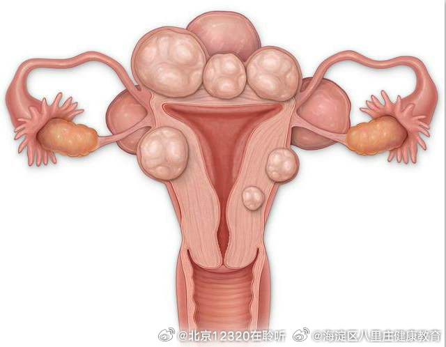 子宮肌瘤的最佳治療方法，全面解析與指導，子宮肌瘤的最佳治療方法詳解與指導手冊