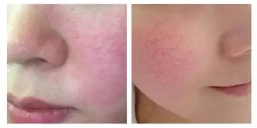 臉頰紅血絲如何修復(fù)，全面解析與實(shí)用建議，臉頰紅血絲全面解析與修復(fù)實(shí)用建議