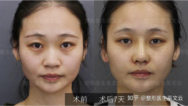 縮鼻翼手術(shù)，重塑美麗鼻型的最佳選擇，縮鼻翼手術(shù)，重塑美麗鼻型的優(yōu)選之道