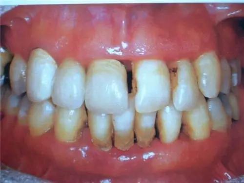 牙齦萎縮初期圖片及其相關(guān)知識解析，牙齦萎縮初期圖片與相關(guān)知識詳解
