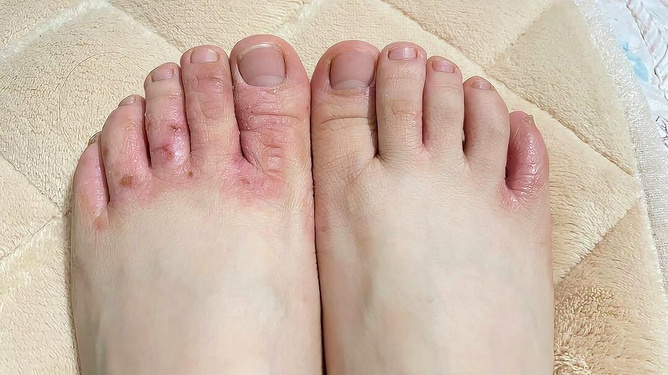 腳氣爛腳趾縫癢潰爛的治療方法，全面解析與應(yīng)對策略，腳氣爛腳趾縫癢潰爛全面解析與治療策略