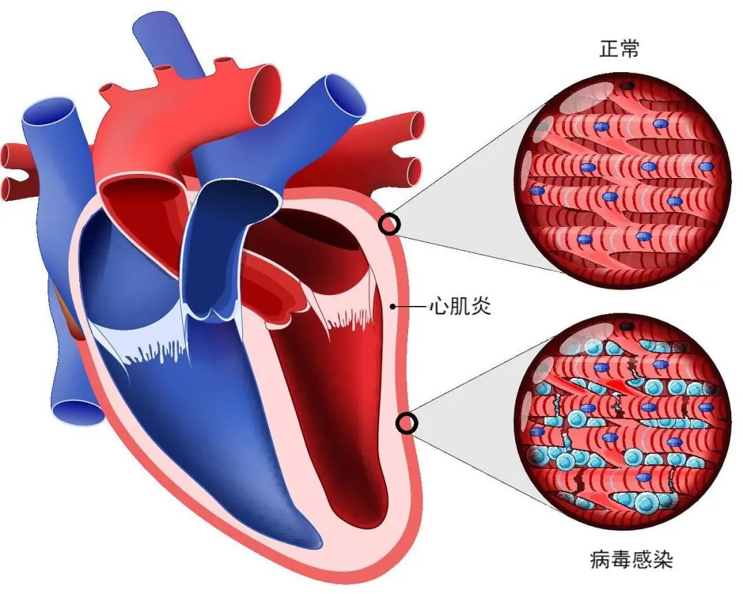 心肌炎，了解、預(yù)防與治療的重要性，心肌炎，了解、預(yù)防與治療的至關(guān)重要性