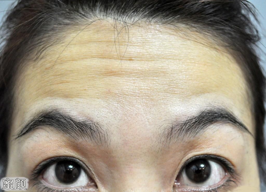 消除抬頭紋最簡單方法，實用指南與技巧，消除抬頭紋的有效方法與實用指南