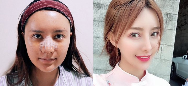 整鼻子老了之后圖片，深度探討鼻子整形手術(shù)的長遠(yuǎn)影響與變化，深度探討，鼻子整形手術(shù)的長遠(yuǎn)影響與變化——鼻子老化后的圖片解析