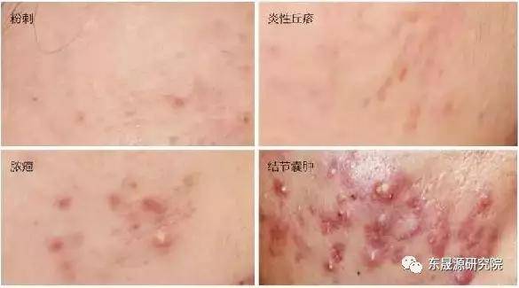 外陰長了個大痘像粉刺怎么辦？全面解析與應(yīng)對建議，外陰粉刺狀大痘的解決方法，全面解析與應(yīng)對建議