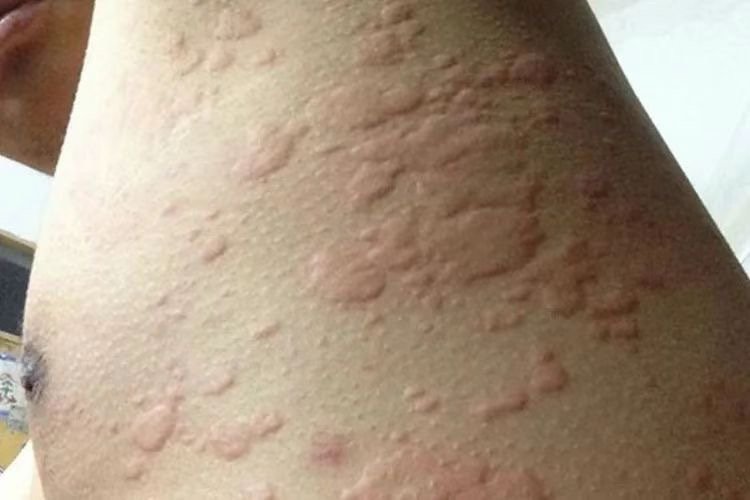 蕁麻疹最怕一個克星——揭示蕁麻疹的天然敵人，蕁麻疹的天然克星，揭示其真正的敵人