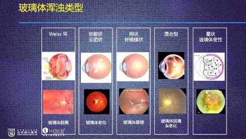 玻璃體混濁可以恢復(fù)嗎？解析與應(yīng)對(duì)之道，玻璃體混濁能否恢復(fù)？解析、應(yīng)對(duì)及治療方法探討