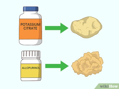腎結(jié)石最快的排出方法，全面解析與實用建議，全面解析與實用建議，腎結(jié)石快速排出方法指南