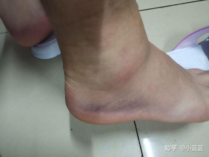 腳踝消腫的最快方法，全面解析與實用指南，腳踝消腫快速方法，全面解析與實用指南