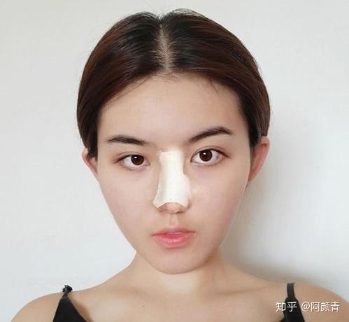 做了鼻子后相貌都變了——探索鼻整形術(shù)的魅力與影響，鼻整形術(shù)，探索鼻子變化對相貌的深遠(yuǎn)影響與魅力展現(xiàn)