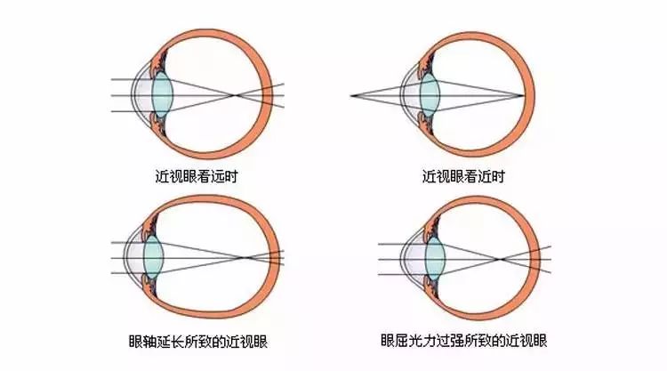 假性近視，成因、預(yù)防與改善策略，假性近視，成因解析、預(yù)防方法與改善策略