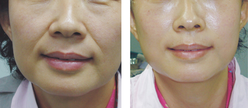 玻尿酸臉部注射后的老化現(xiàn)象解析，玻尿酸臉部注射后的老化現(xiàn)象探究