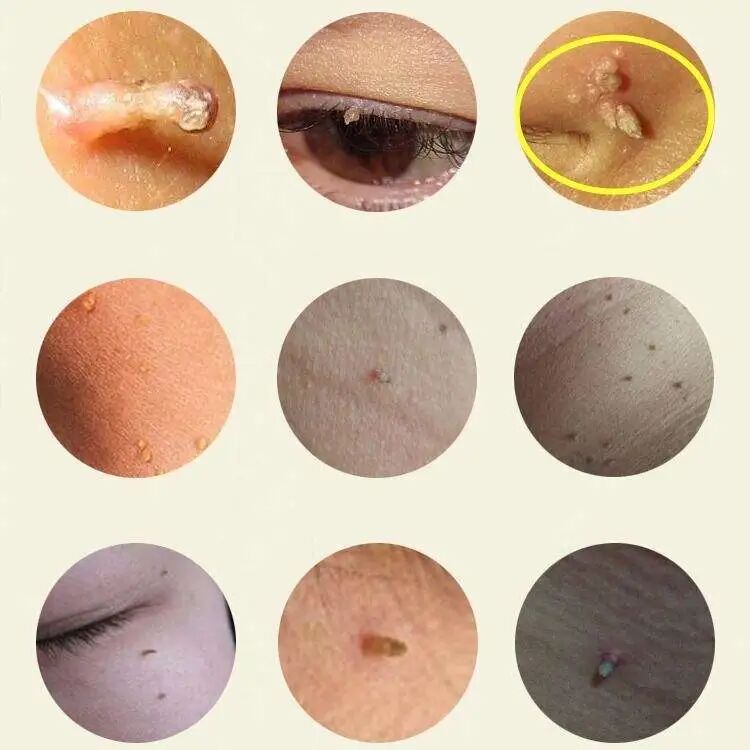 肉粒疣圖片，了解、識別與防治，肉粒疣圖片詳解，識別、防治全攻略